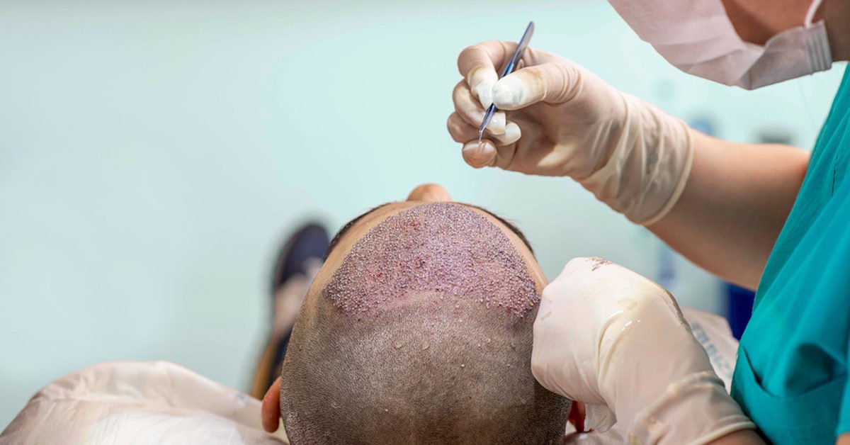 Hair loss can be very frustrating as it is seen as a huge social stigma